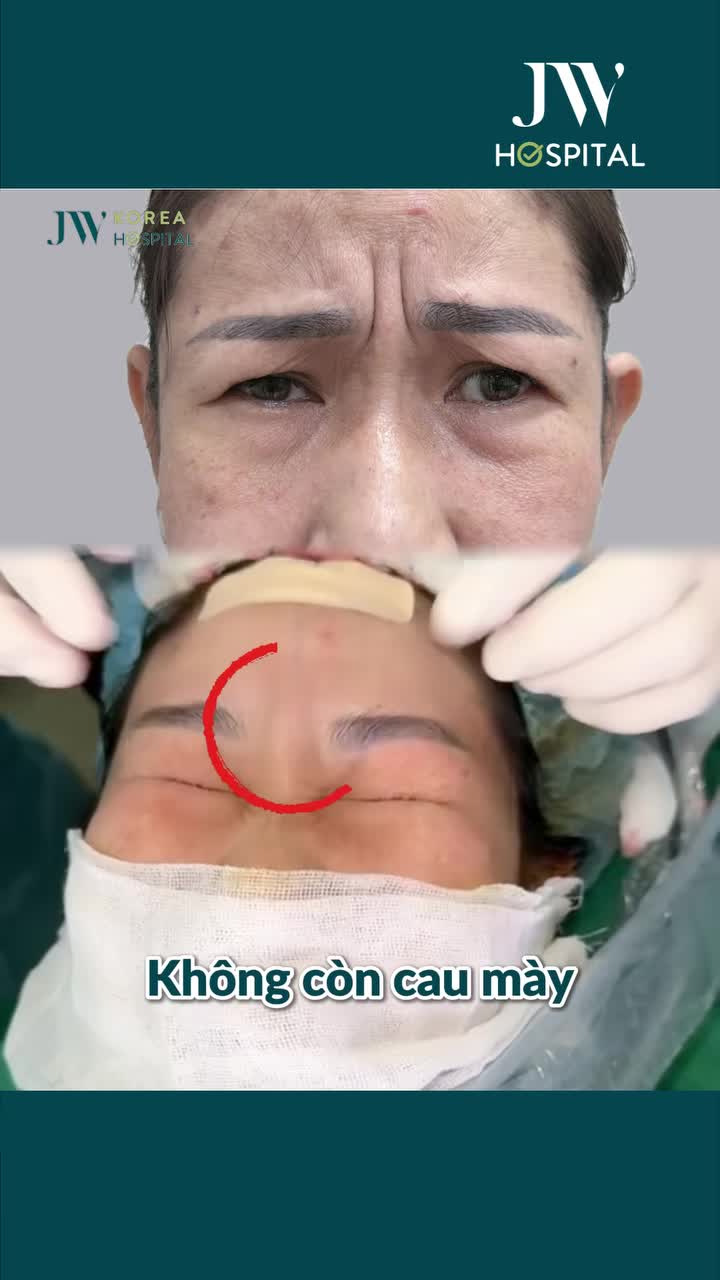 BÁC SĨ TÚ DUNG CẮT CƠ CAU MÀY NỘI SOI 1 ĐIỂM – GIÚP QUÝ CÔ U50 TRẺ 10 TUỔI SAU 30 PHÚT, KΗÔΝG SẸΟ