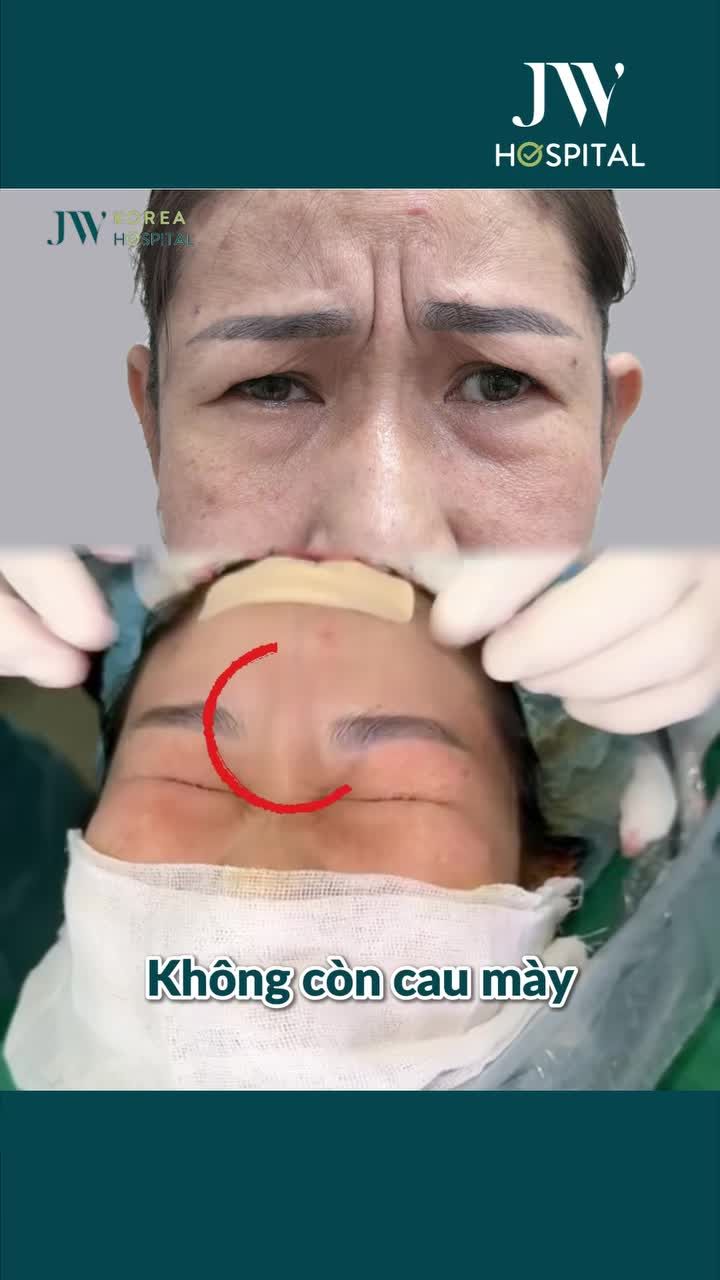 BÁC SĨ TÚ DUNG CẮT CƠ CAU MÀY NỘI SOI 1 ĐIỂM – GIÚP QUÝ CÔ U50 TRẺ 10 TUỔI SAU 30 PHÚT, KΗÔΝG SẸΟ