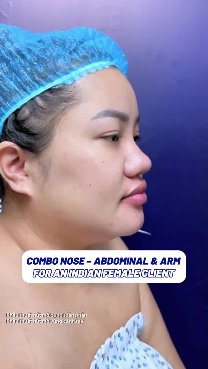 Nữ khách Ấn Độ hài lòng sau 1 ngày giảm mỡ bụng, tay và nâng mũi tại Gangwhoo