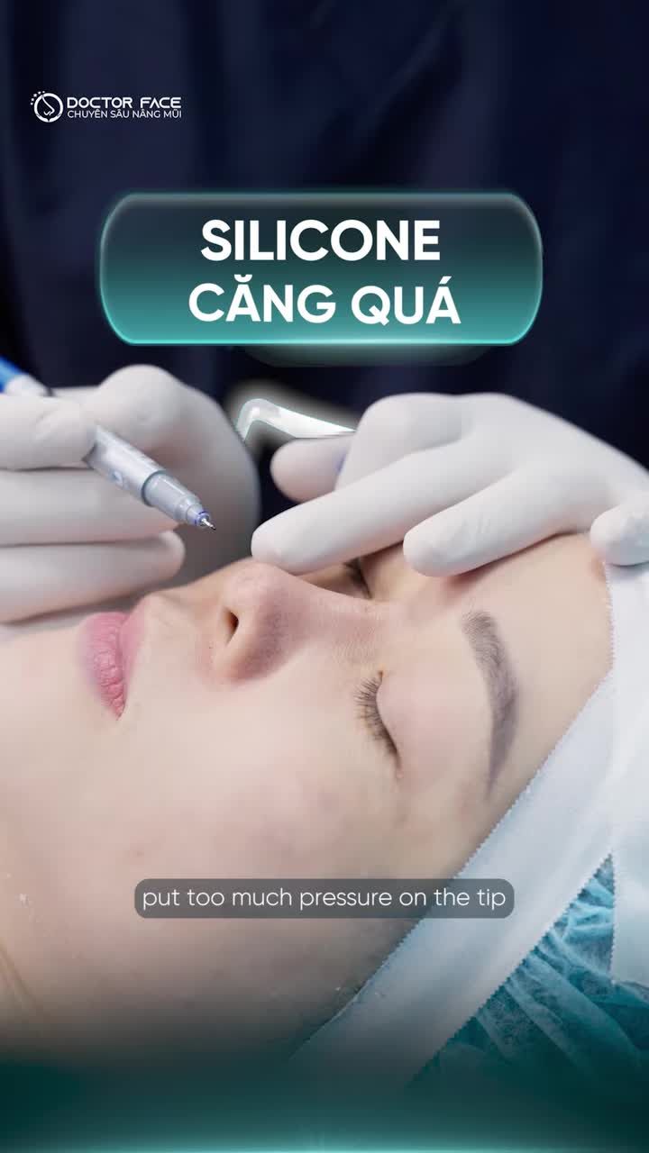 Tháo sụn rồi, mũi đã thực sự ổn?