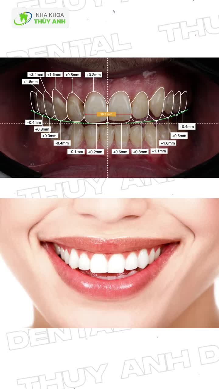 KHÔNG CẮT LỢI, KHÔNG CẮT XƯƠNG – VẬY LÀM SAO ĐỂ CẢI THIỆN CƯỜI HỞ LỢI?