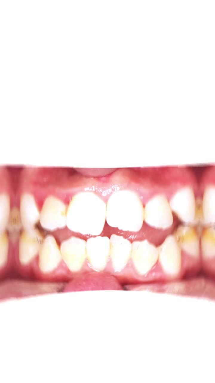 Niềng răng ở Viet Smile đã thay đổi bạn như thế nào?