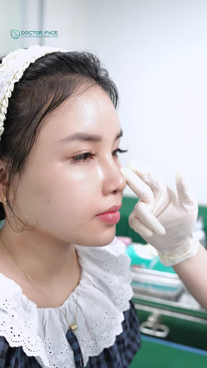Một dáng mũi sau 4 năm đã góp phần vào quyết định nâng mũi của chị.