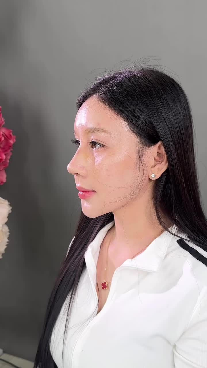 Mũi cấu trúc sửa lại sau 12 ngày