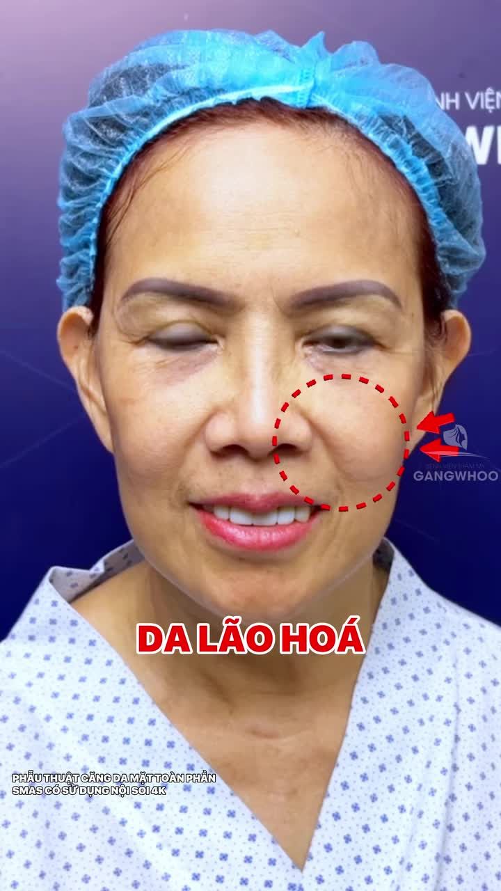 Động lực cho các chị em còn đang băn khoăn có nên căng da mặt Smas có sử dụng nội soi 4K tại Bệnh viện thẩm mỹ Gangwhoo trẻ hóa - không đau - an toàn