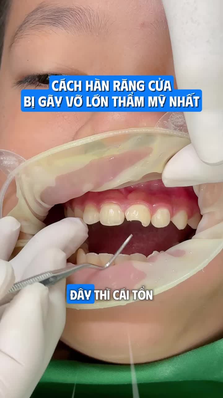 RĂNG CỬA VỠ LỚN – HÀN TRÁM GIÚP KHÔI PHỤC TỪNG CHI TIẾT NHỎ
