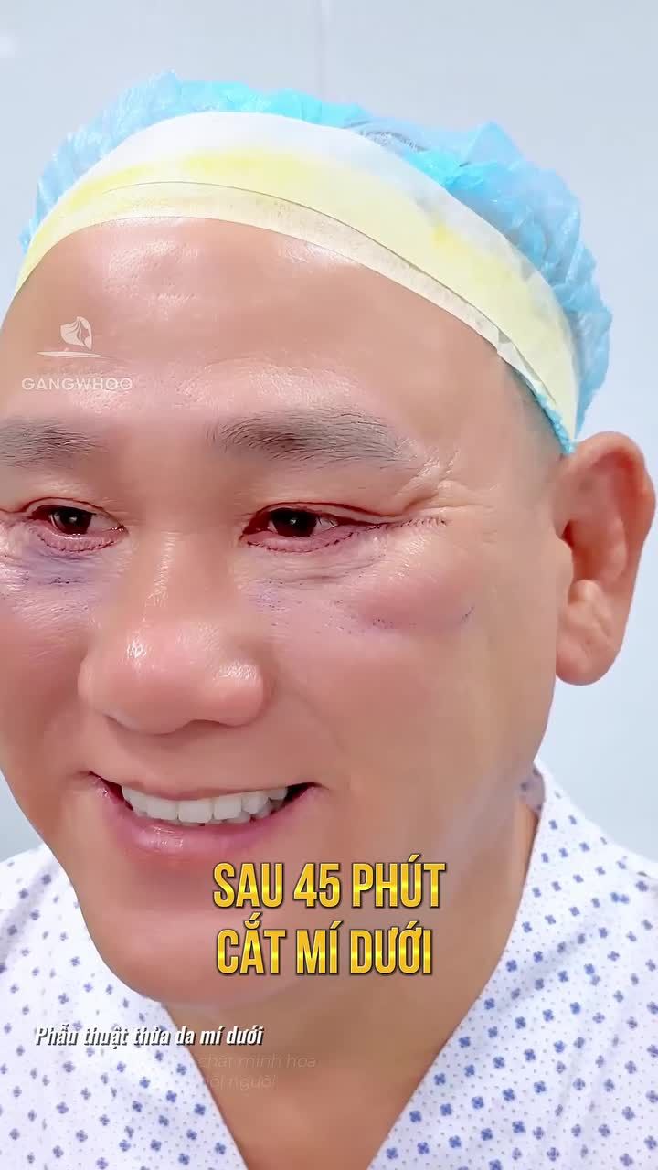 Sở hữu đôi mắt trẻ trung sau 45 phút cắt mí dưới Perfect
