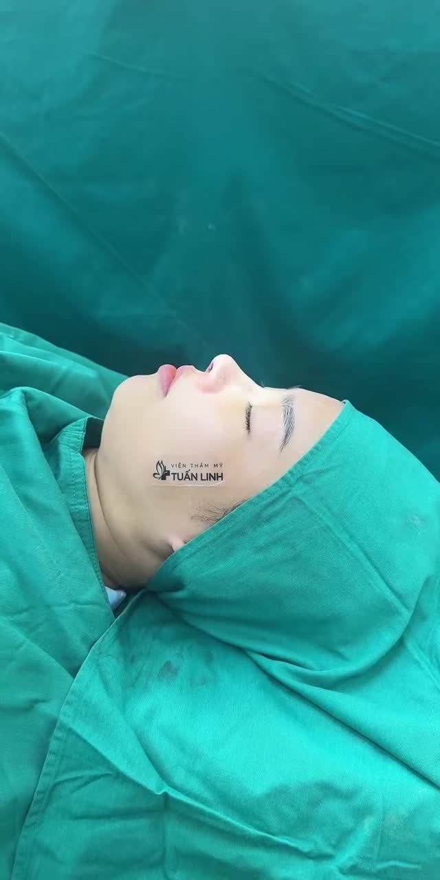 NÂNG MŨI CẤU TRÚC SURGIFORM KẾT HỢP XỬ LÝ VÁCH NGĂN