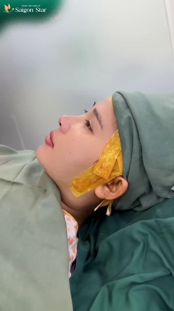 NÂNG MŨI CẤU TRÚC DR. HOẠT - TỪ TỰ TI ĐẾN TỰ TIN