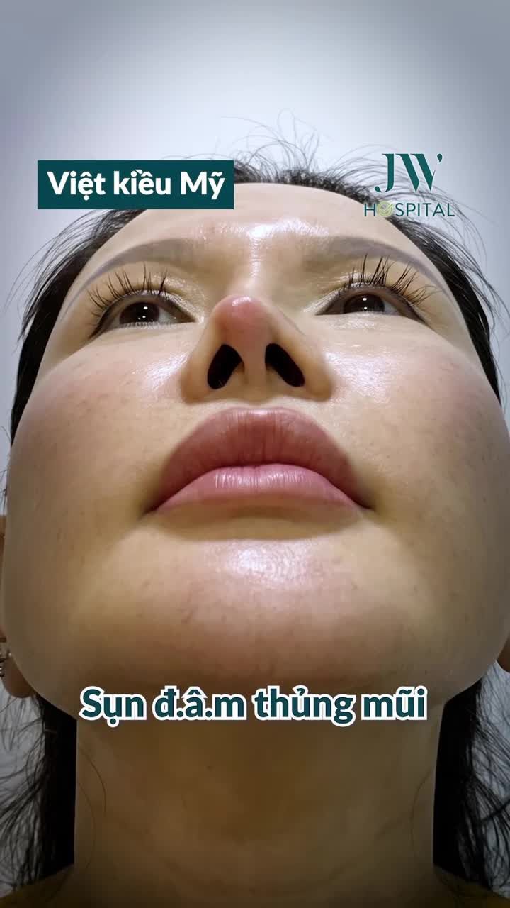 VIỆT KIỀU MỸ NÂNG MŨI HỎNG LỘ SỐNG, BÓNG ĐỎ – 7 NGÀY TÁI SINH DIỆN MẠO MỚI VỚI NÂNG MŨI S LINE TẠI JW