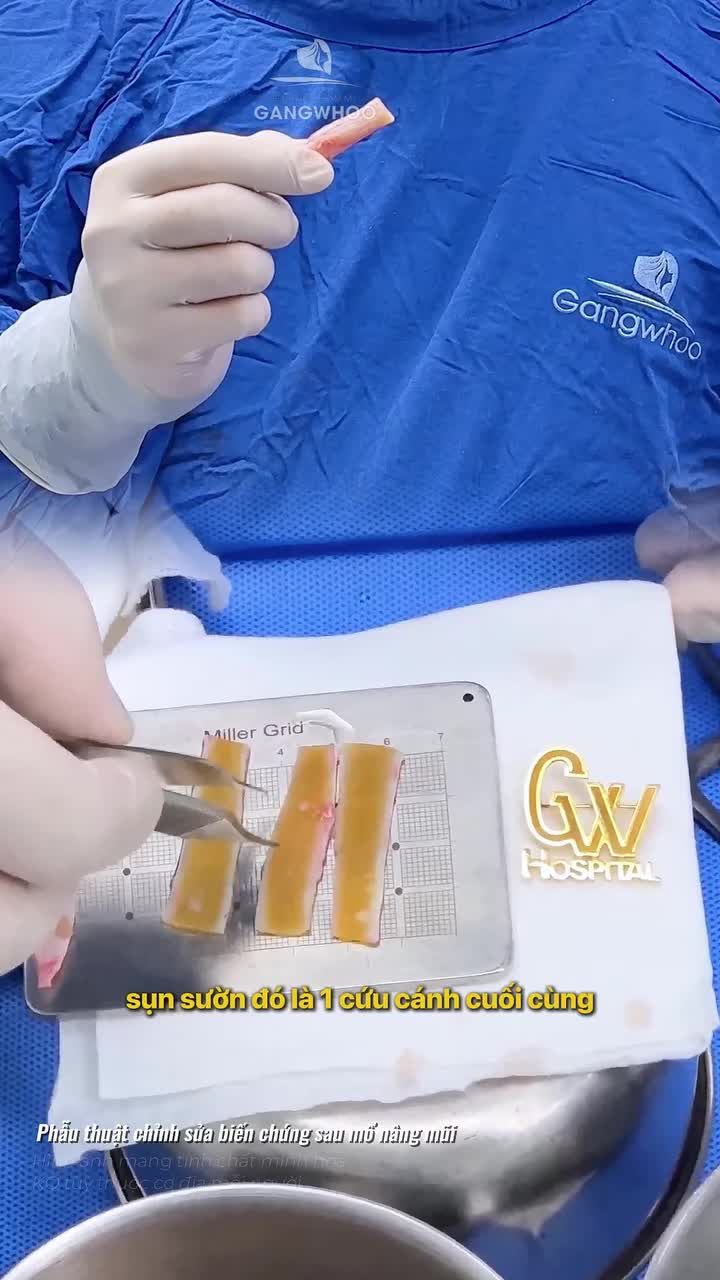 Sụn sườn là cứu cánh cho những ca mũi hỏng, co rút nặng
