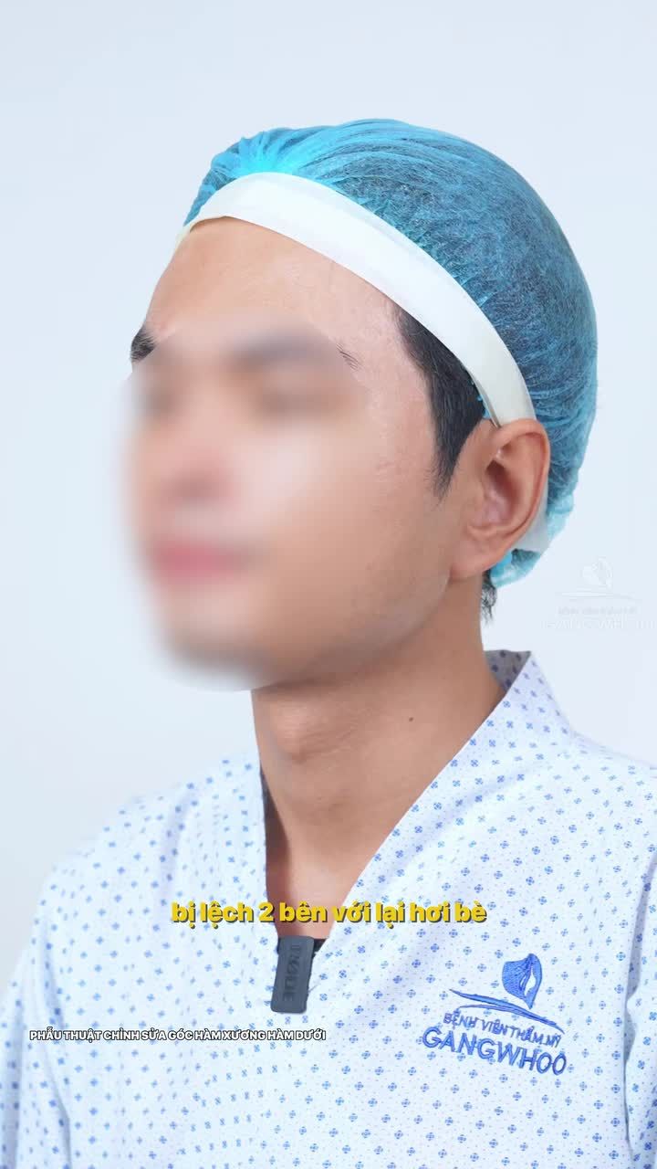 Xương hàm to 2 bên không đồng đều cùng xem quá trình Bác sĩ phân tích và thực hiện với gọt hàm có sử dụng nội soi 4K nhé!