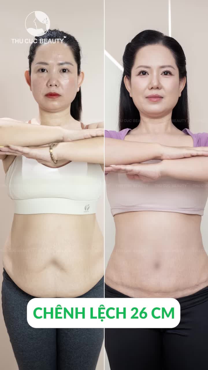 CHÊNH LỆCH 26CM – VÒNG 2 THAY ĐỔI NGOẠN MỤC SAU HÚT MỠ TẠO HÌNH THÀNH BỤNG