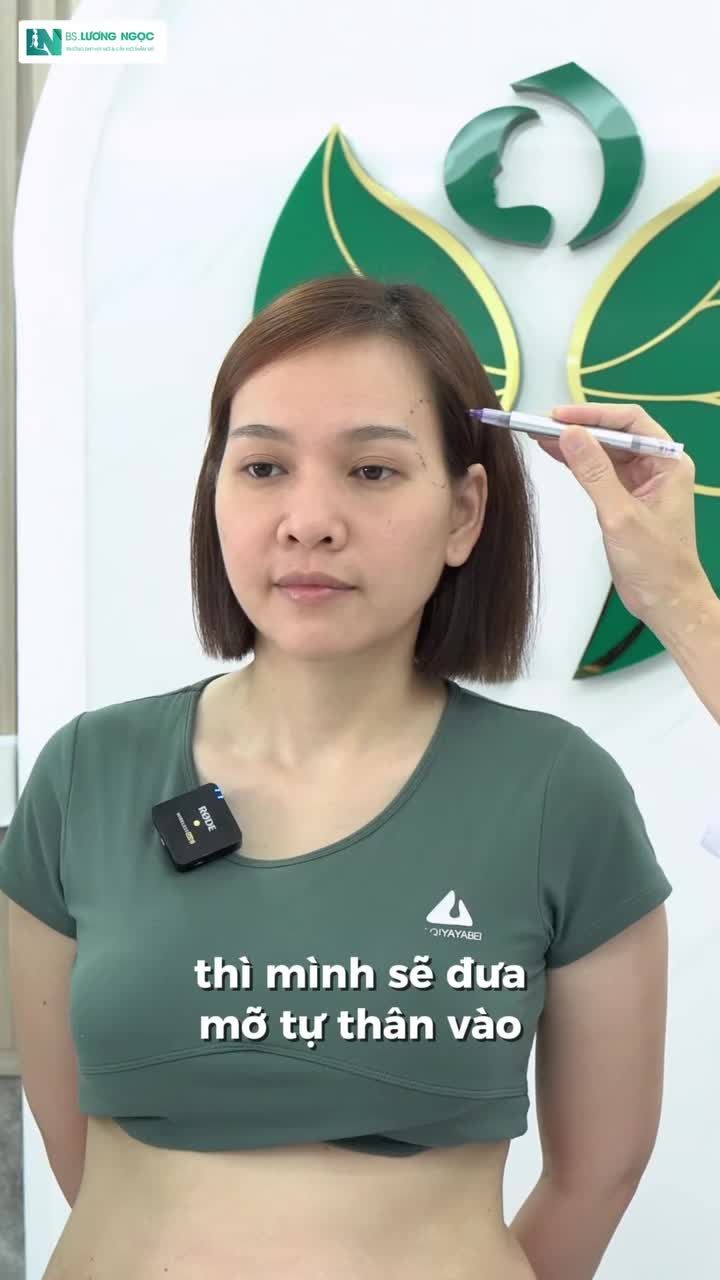 GƯƠNG MẶT THAY ĐỔI RA SAO SAU CẤY MỠ?