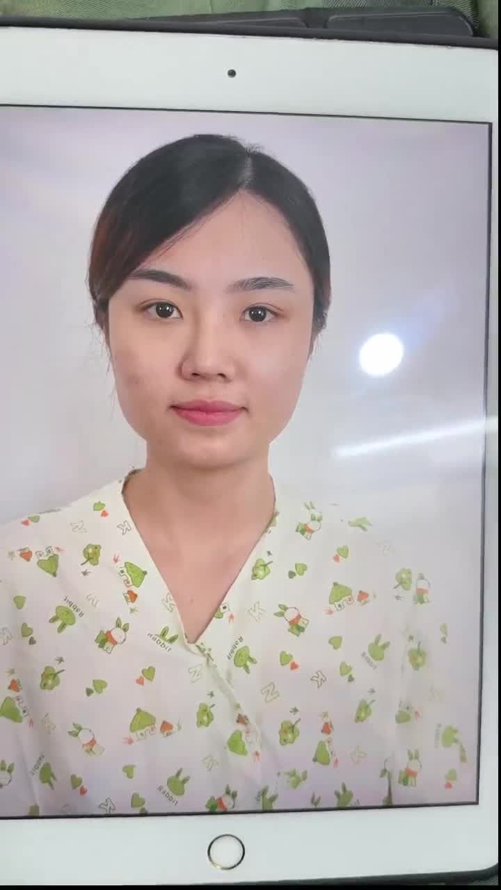 KẾT QUẢ NÂNG MŨI CẤU TRÚC SỬA LẠI KH. MINH MẪN (CỦ CHI)