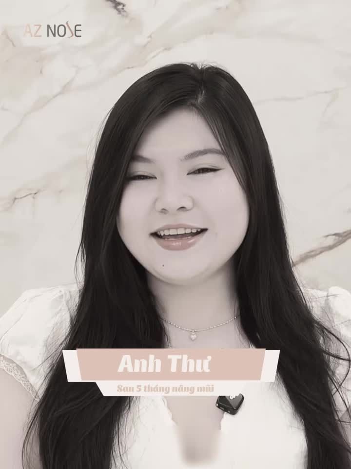 Dáng mũi sau 5 tháng hài hòa và giúp gương mặt thanh thoát hơn