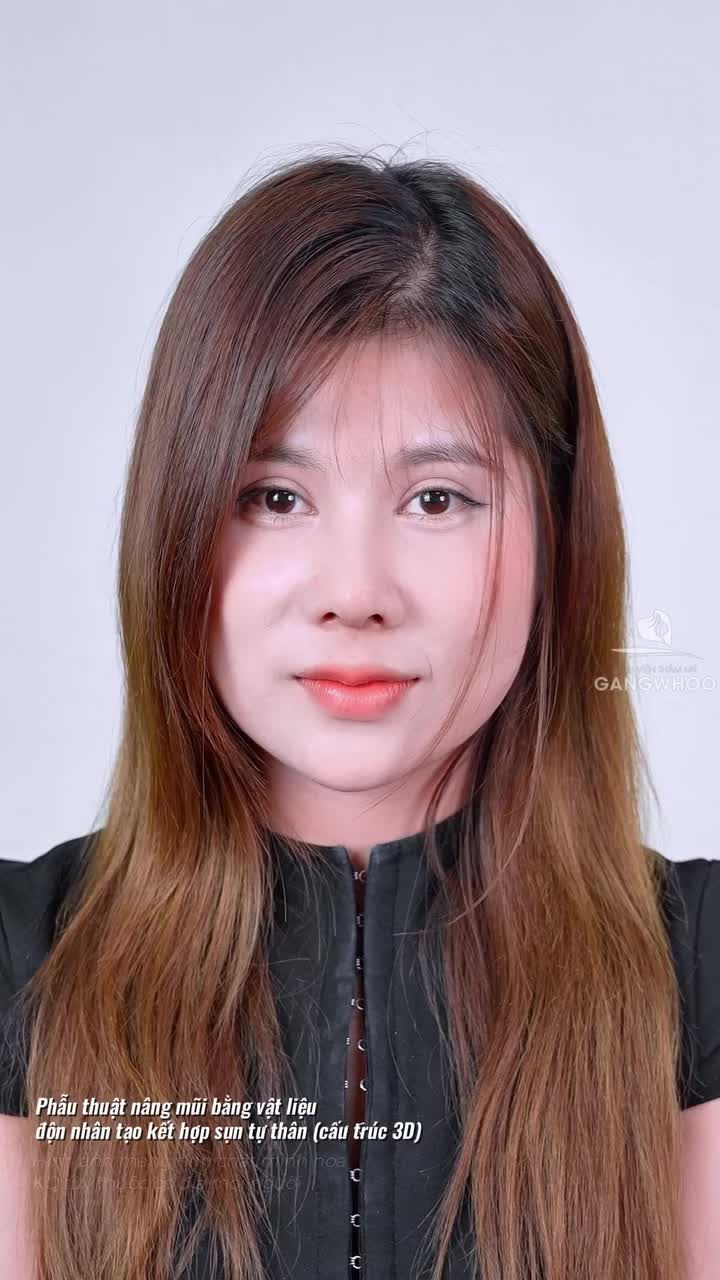 Quyết định nâng mũi và cú biến hình khiến ai cũng ngoái nhìn