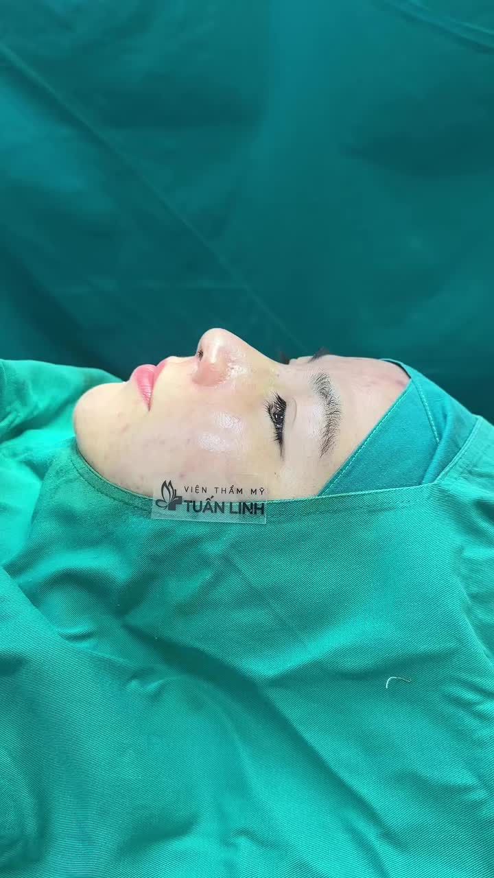 Mũi cấu trúc sau phẫu thuật