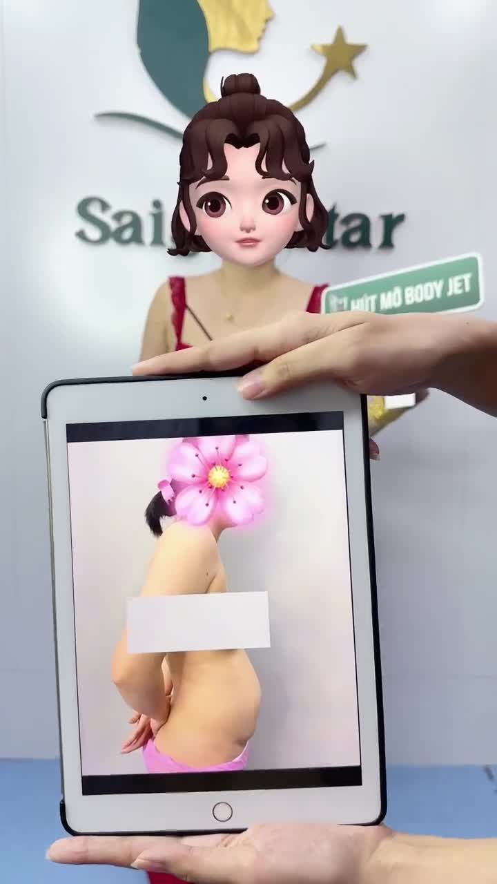 Kết quả sau 1 năm HÚT MỠ BỤNG 360° + CĂNG DA BỤNG