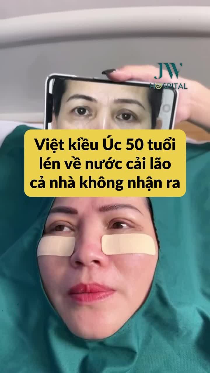XÓA BỌNG MỠ MẮT, RÃNH CƯỜI SÂU - VIỆT KIỀU ÚC U60 NGỠ NGÀNG VỚI DIỆN MẠO TRẺ 20 TUỔI CHỈ SAU 60 PHÚT MIDFACE 3 IN 1