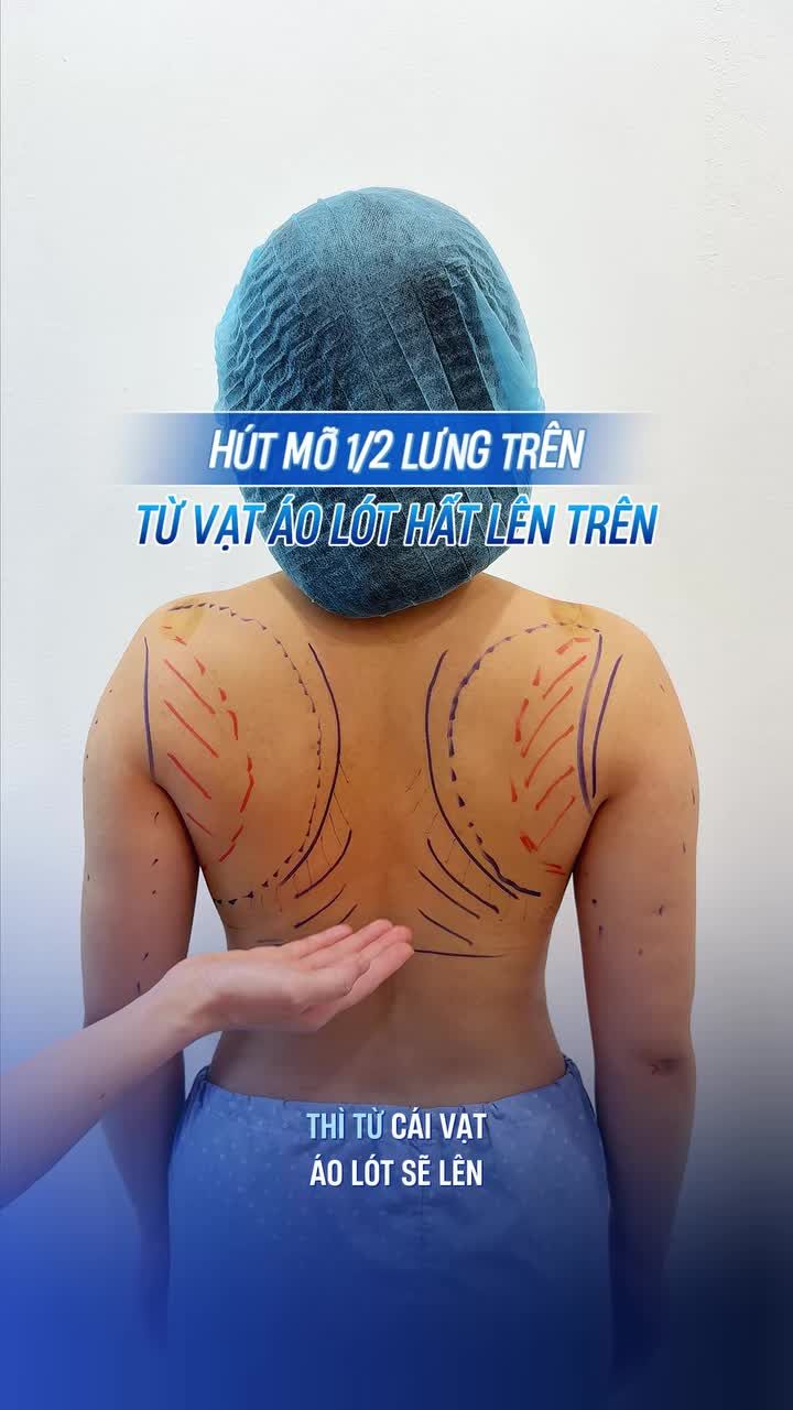 HÚT MỠ 1/2 LƯNG LÀ HÚT Ở ĐÂU? KẾT HỢP CÁNH TAY THÌ KHÁC BIỆT THẾ NÀO?