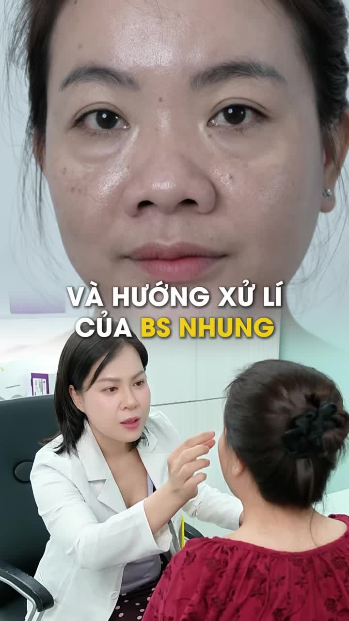 Phương pháp xử lý của BS Hồng Nhung đối với khách hàng gặp bọng mơ mí dưới phì đại và chảy x