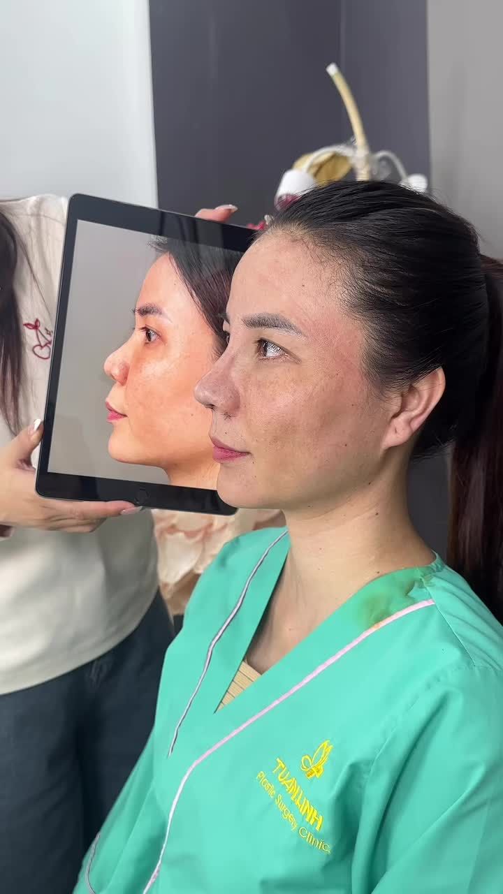 Mũi cấu trúc rút chỉ cuộn cánh surgiform vừa hoàn thành