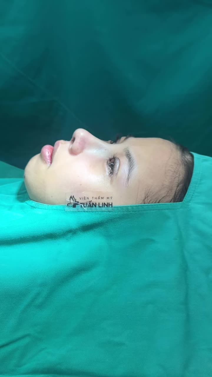 Case combo mũi mí vừa hoàn thành