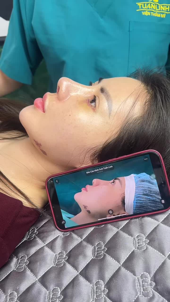 Mũi cấu trúc sửa lại surgiform + midface sau 13 ngày