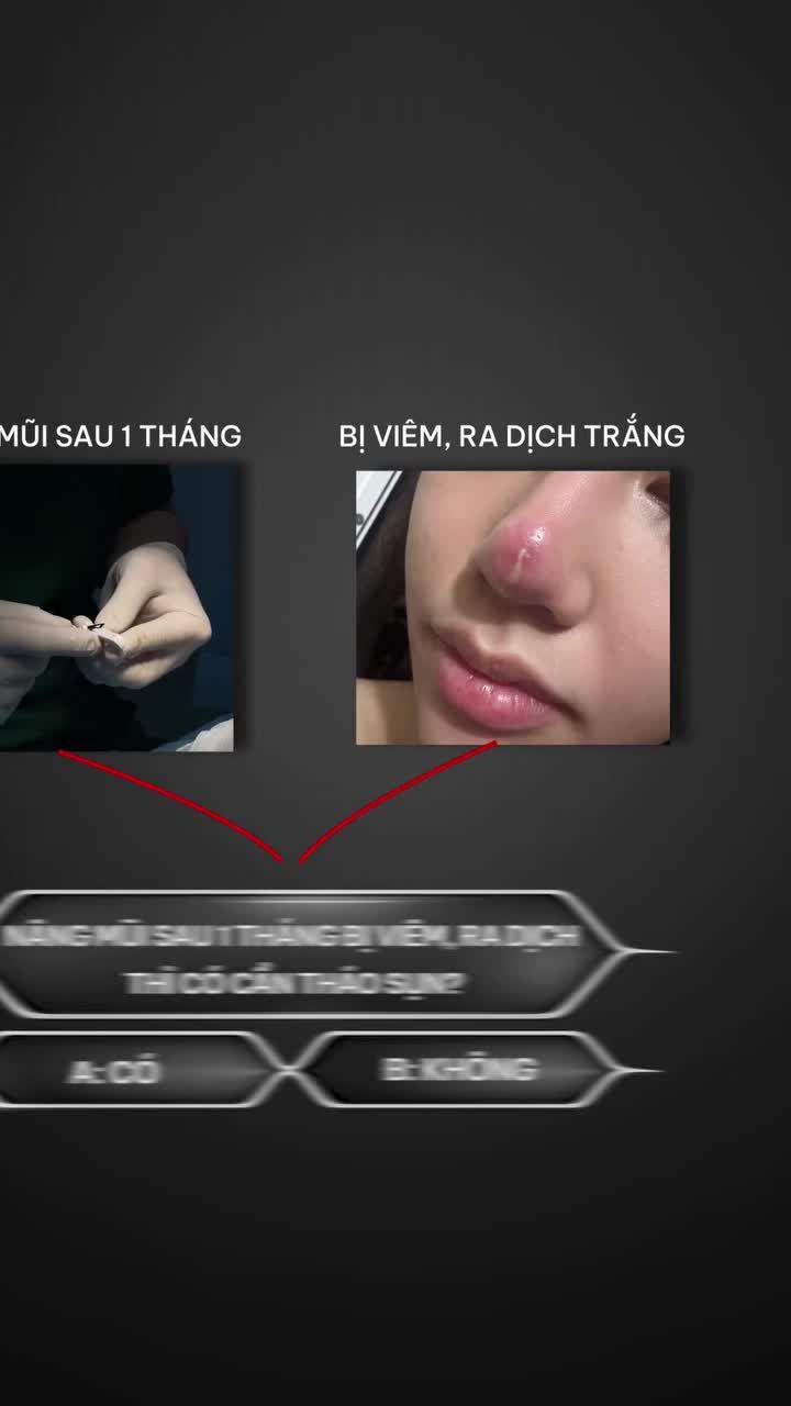 Nâng mũi 1 tháng bị viêm, ra dịch trắng có nhất thiết phải tháo sụn? Cùng nghe Tiến sĩ Tống Hải phân tích và giải đáp dưới góc nhìn chuyên môn nhé