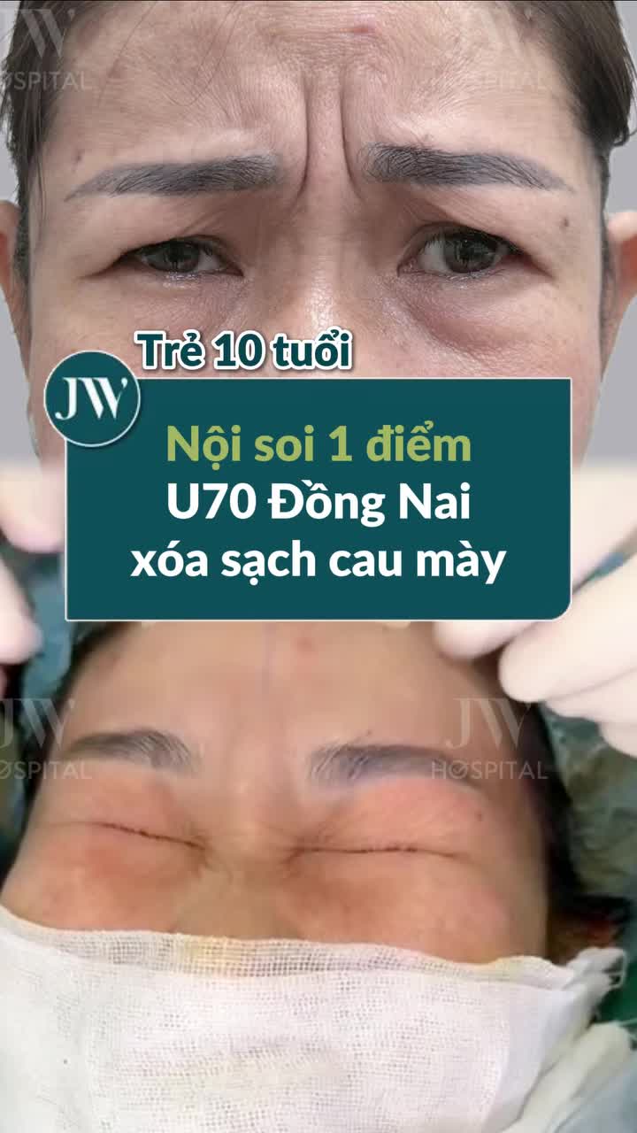U70 ĐỒNG NAI LÊN SÀI GÒN TÌM BÁC SĨ TÚ DUNG – C.ẮT CƠ CAU MÀY NỘI SOI 1 ĐIỂM TRẺ HÓA 10 TUỔI, SẸO VÔ HÌNH