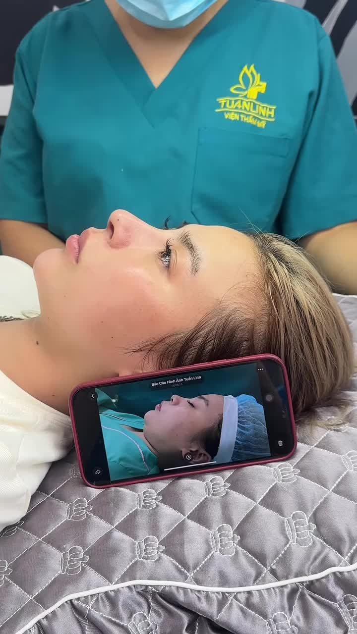 Mũi cấu trúc bioform sau 15 ngày