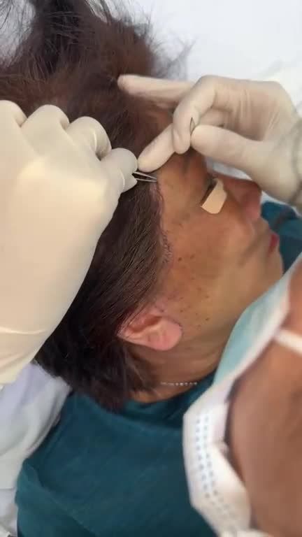 Công khai diện mạo TRẺ 20 TUỔI không sẹo của Việt kiều Mỹ U70 sau 10 ngày thực hiện CĂNG DA MẶT + MIDFACE 3 IN 1 tại JW