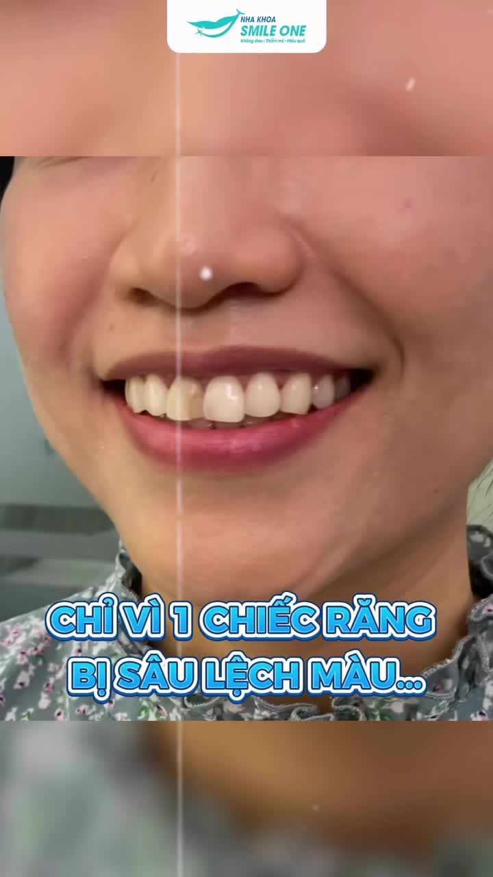 Xem thêm 44 video Bọc Răng Sứ của bác sĩ Bs nha khoa Smile One