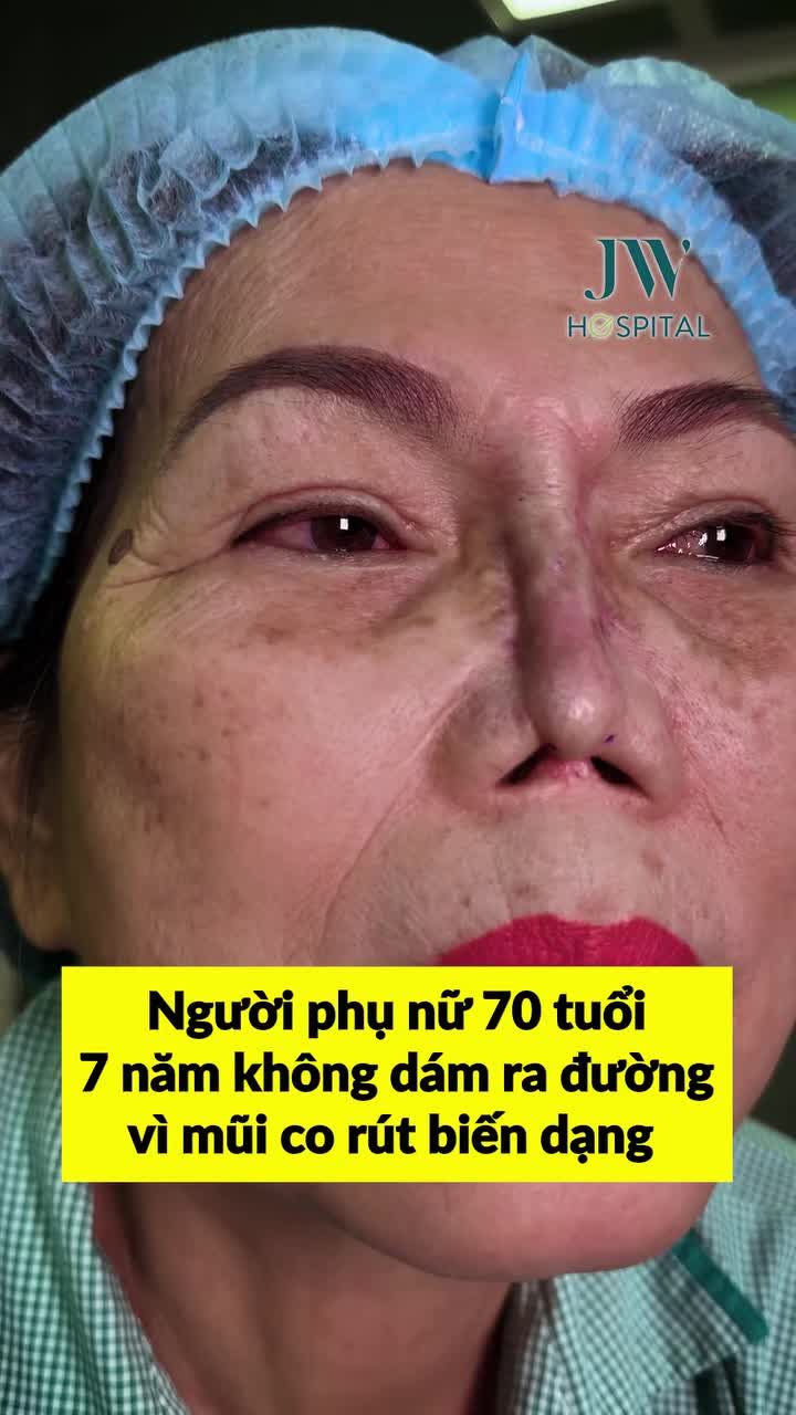 BÁC SĨ TÚ DUNG LÀM GÌ ĐỂ CỨU NGƯỜI PHỤ NỮ 70 TUỔI MŨI CO RÚT, BIẾN DẠNG SUỐT 7 NĂM