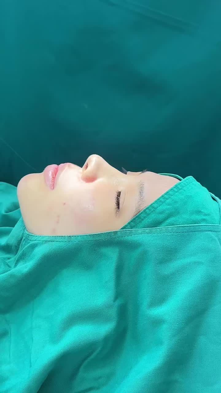 Mũi bọc sụn