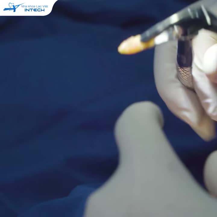 CẬN CẢNH QUÁ TRÌNH CẤY GHÉP IMPLANT RĂNG CỬA HÀM DƯỚI