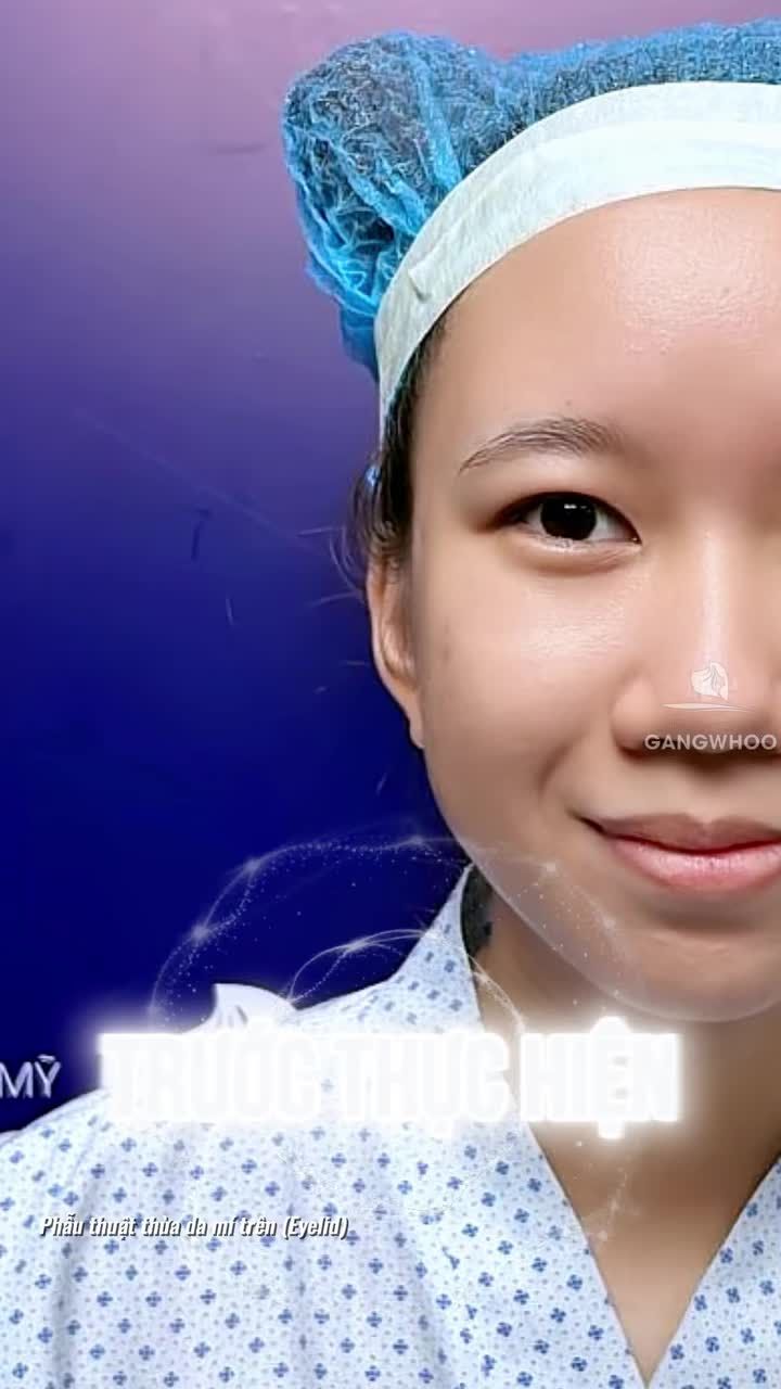 Kết quả sau 7 ngày cắt mí khiến ai cũng mê mẫn