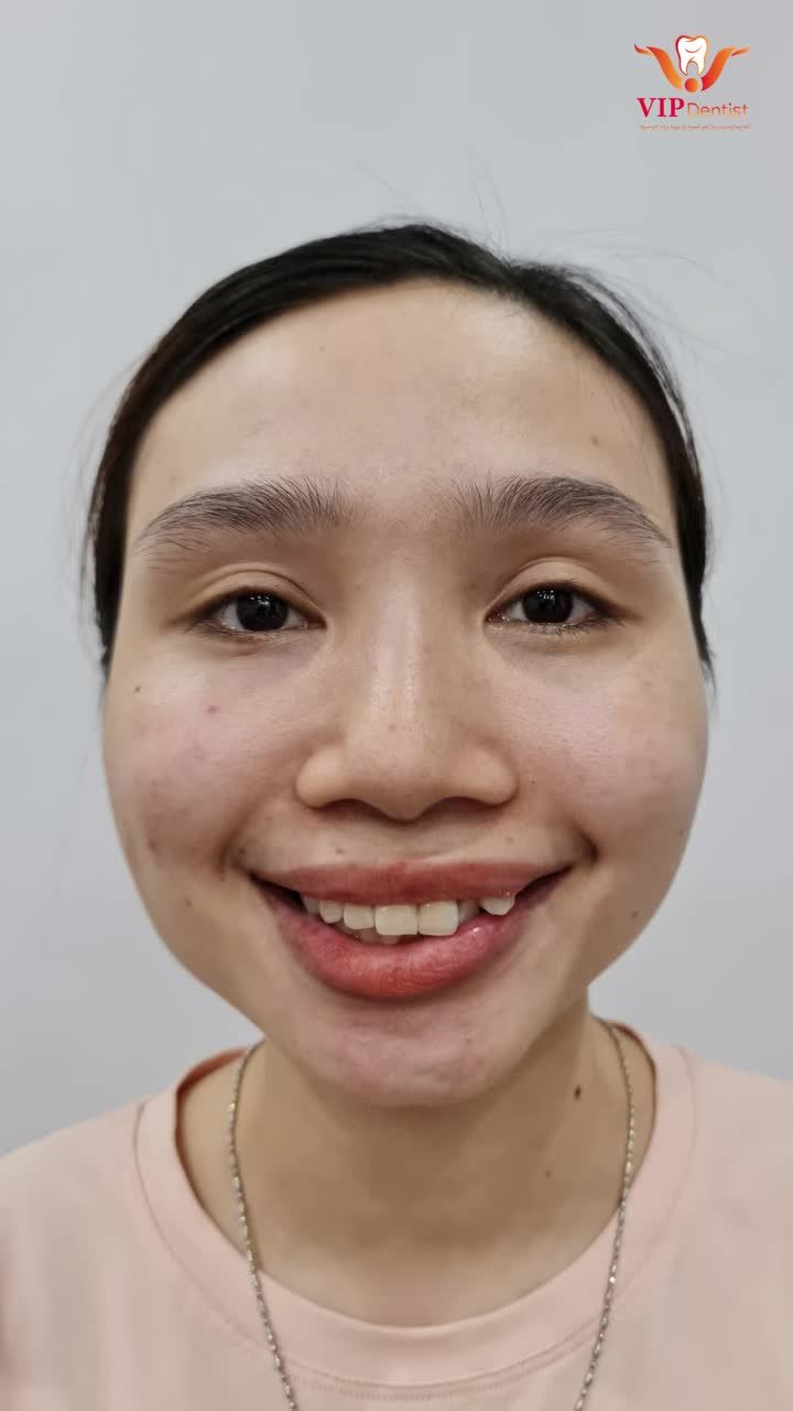 U40 VÀ SỰ THAY ĐỔI ĐÁNG KINH NGẠC NHỜ NIỀNG RĂNG TẠI VIP DENTIST!