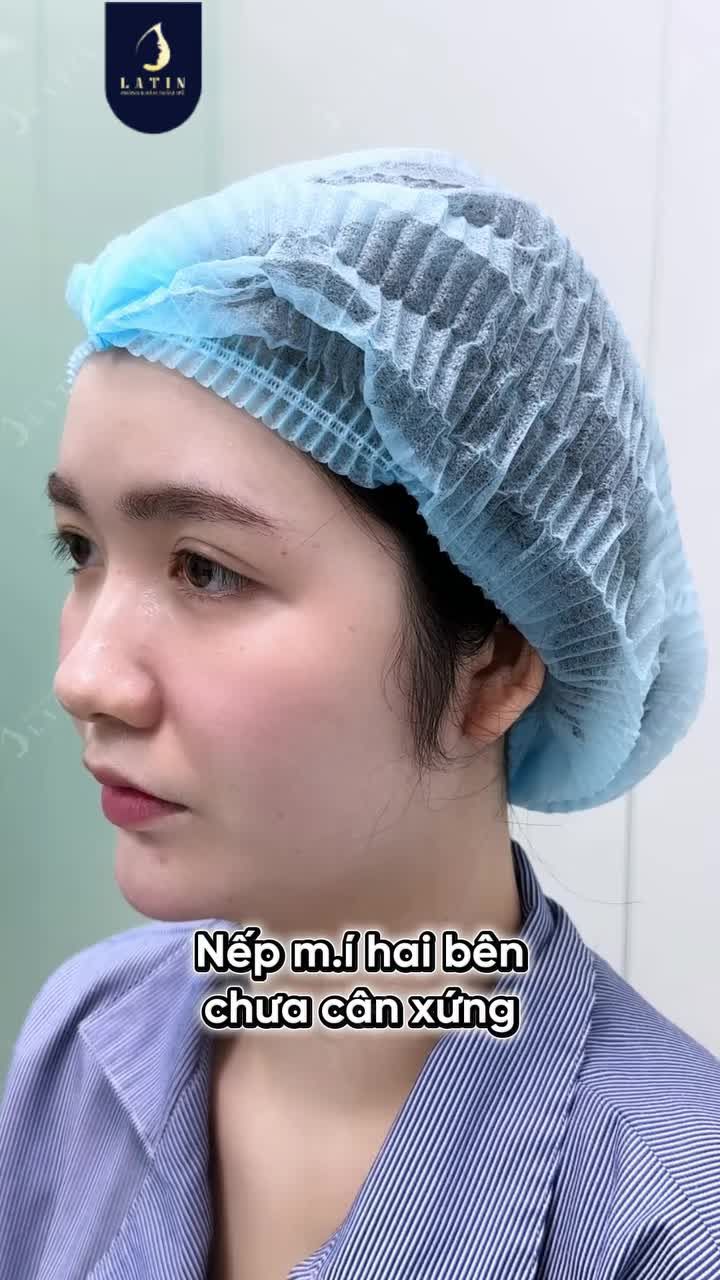 "CẢNH BÁO" CÓ BIẾN HÌNH VỚI COMBO MŨI +MÍ