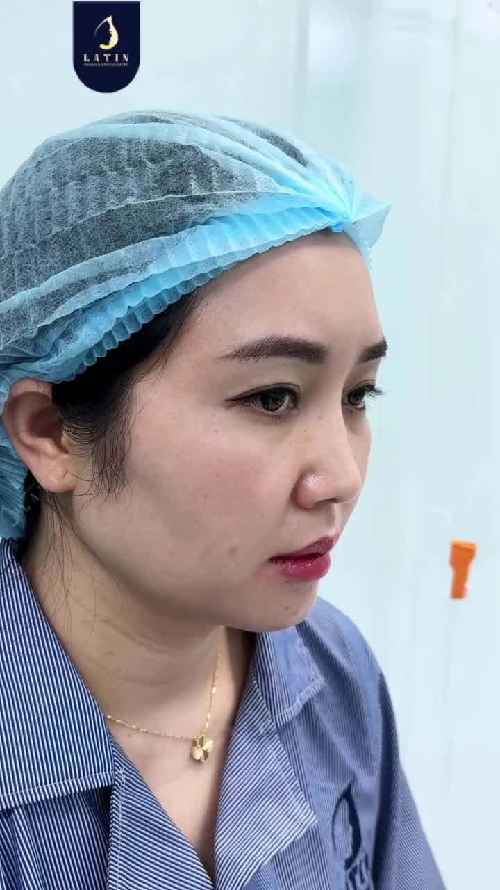 MŨI KHÔNG THẤP, SAO VẪN CHỌN NÂNG CẤU TRÚC?