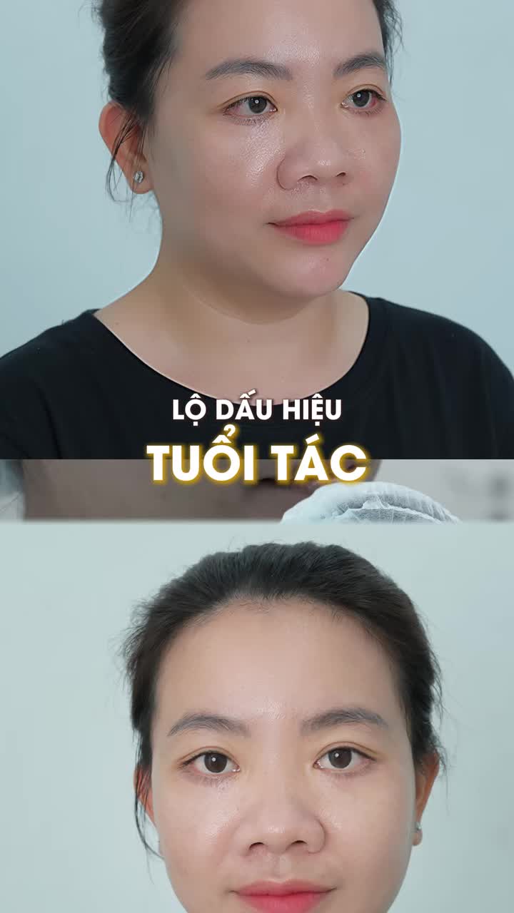 Từng tự ti vì bọng mơ mắt sa trễ, phì đại, lộ rõ dấu hiệu tuổi tác.
