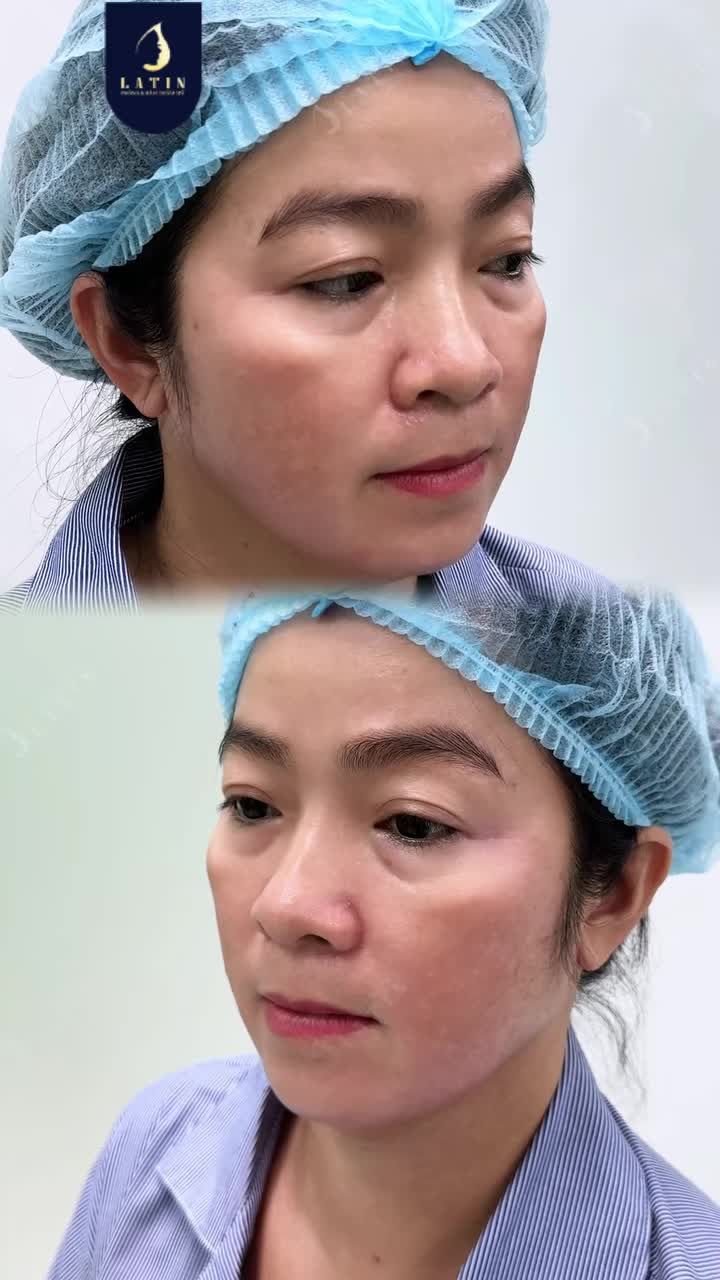 CẮT MÍ DƯỚI, TIÊM MÔI… GƯƠNG MẶT THAY ĐỔI RA SAO?