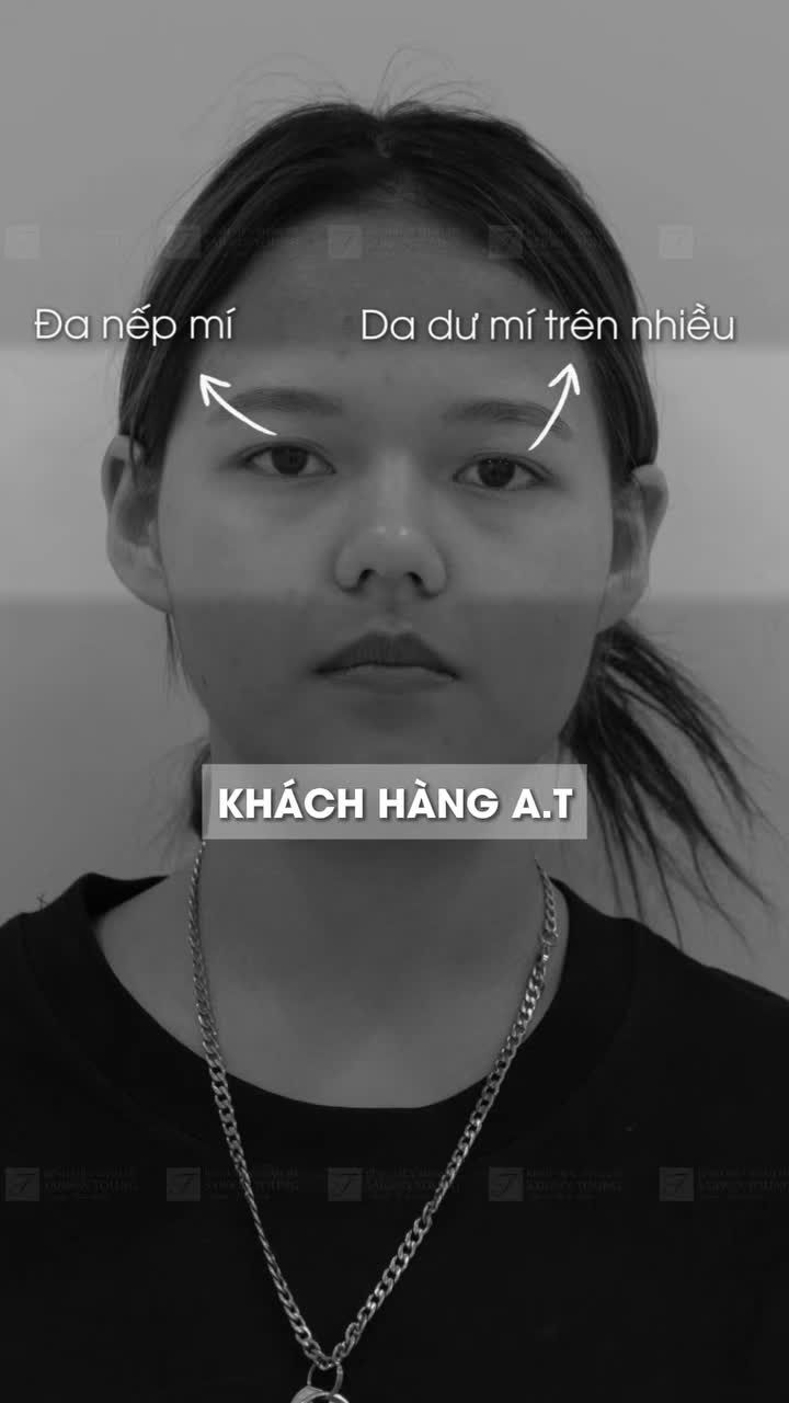 Cảm ơn những "nàng thơ" xinh yêu đã luôn tin tưởng và lựa chọn Bệnh viện thẩm mỹ Saigon Young để thăng hạng nhan sắc với dịch vụ Cắt mí!