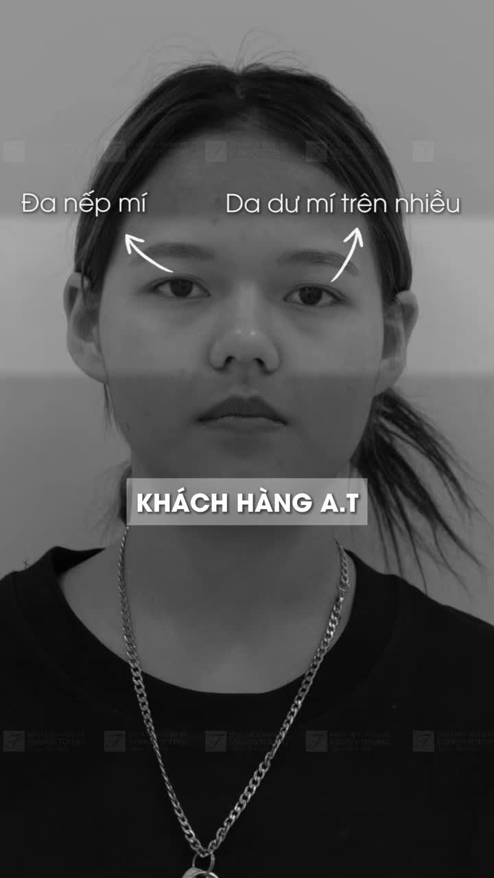 Cảm ơn những "nàng thơ" xinh yêu đã luôn tin tưởng và lựa chọn Bệnh viện thẩm mỹ Saigon Young để thăng hạng nhan sắc với dịch vụ Cắt mí!