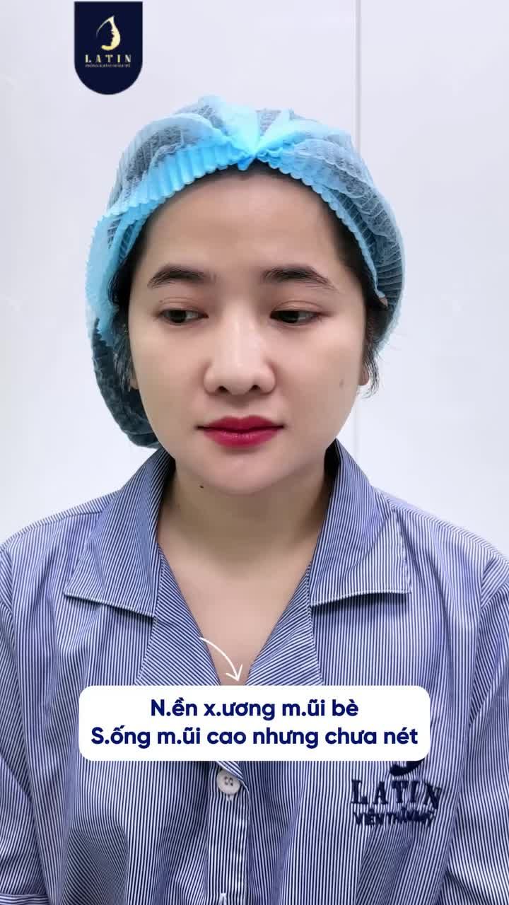 MŨI CAO MÀ BÈ SỬA SAO CHO THANH THOÁT?