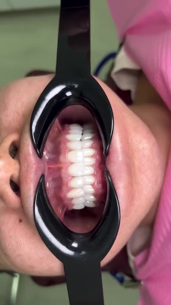 "ĐẸP TỰ NHIÊN ĐẾN MỨC... KHÔNG AI BIẾT BẠN ĐÃ BỌC RĂNG SỨ!"