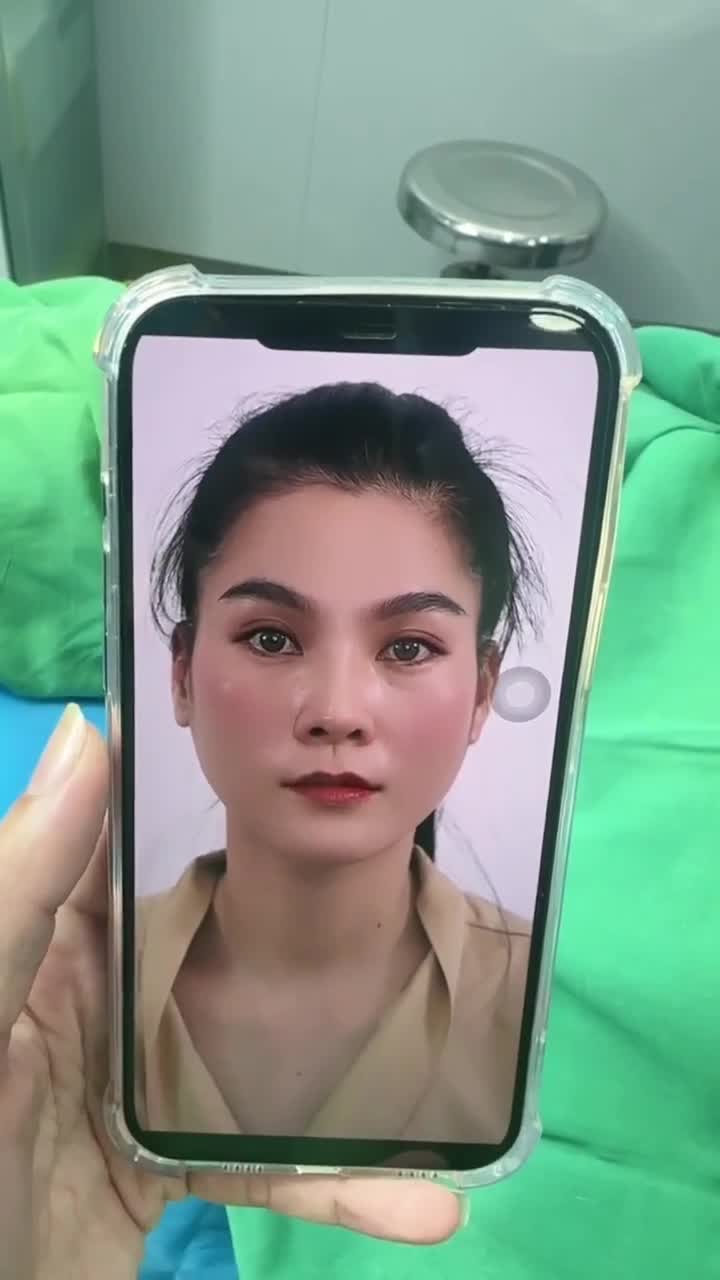 KẾT QUẢ NÂNG MŨI CẤU TRÚC SỬA LẠI KH. KIM OANH