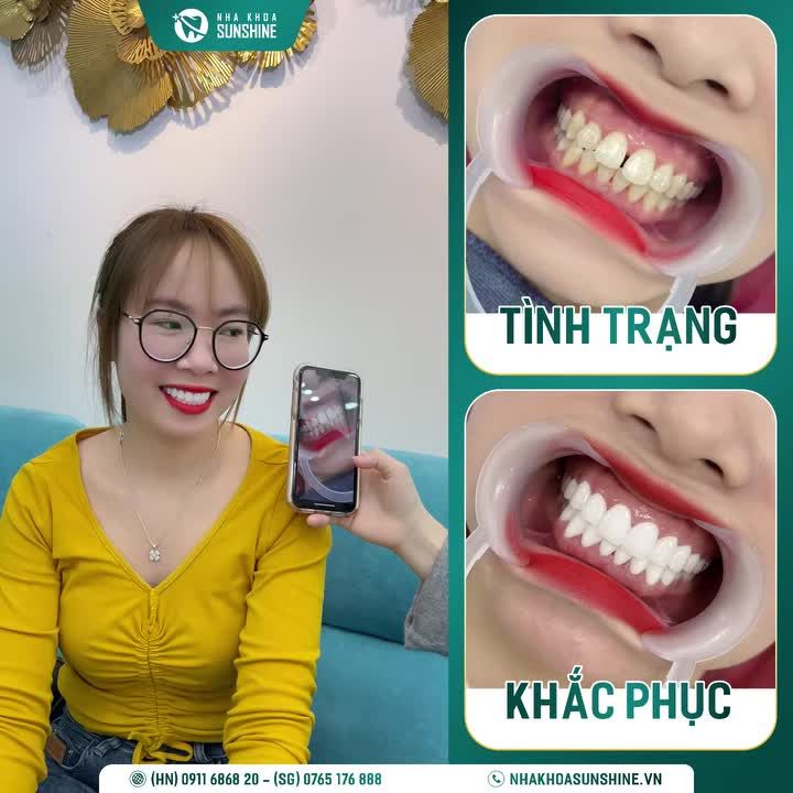 "BỌC RĂNG SỨ CÓ ĐAU KHÔNG? LẮNG NGHE REVIEW THỰC TẾ!"