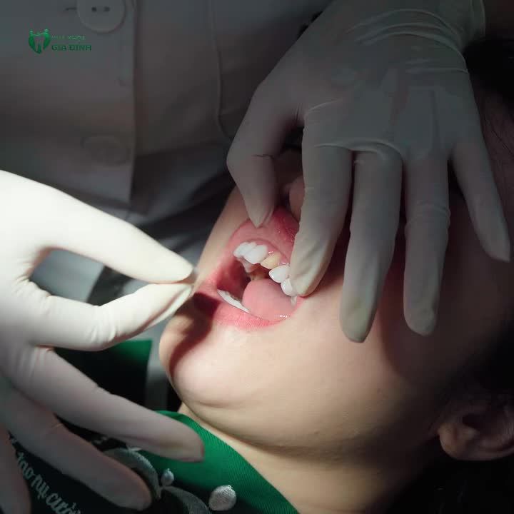 LÀM RĂNG SỨ TẠI NHA KHOA GIA ĐÌNH - KHÔNG LO MÀI NHỎ RĂNG